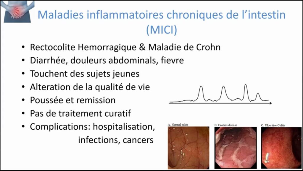 Maladies inflammatoires chroniques de l'intestin (MICI)